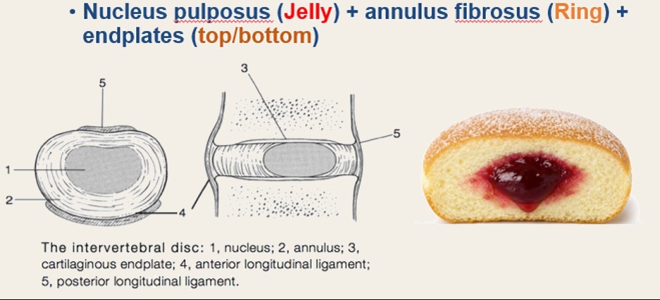 Diagram of the intervertebral disc beside a jelly doughnut: nucleus, annulus, and endplates