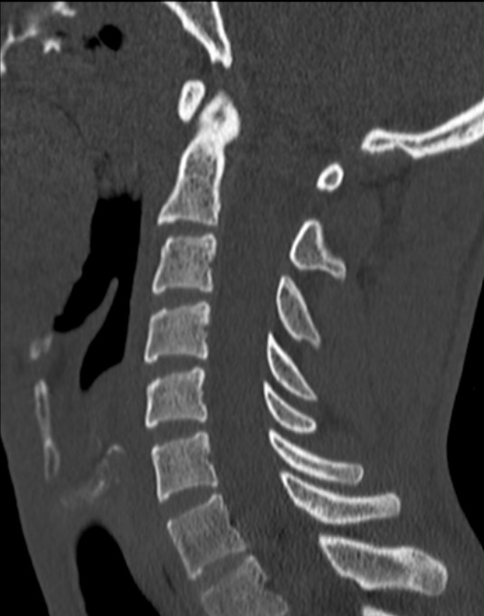 Normal cervical spine CT sagittal