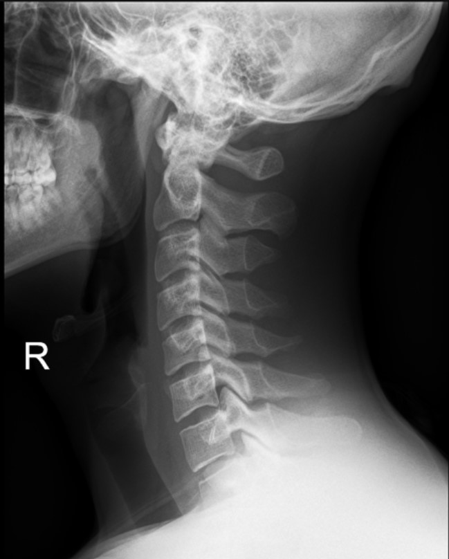 Normal cervical spine lateral x-ray