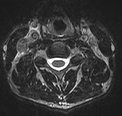 Normal cervical spine MRI axial