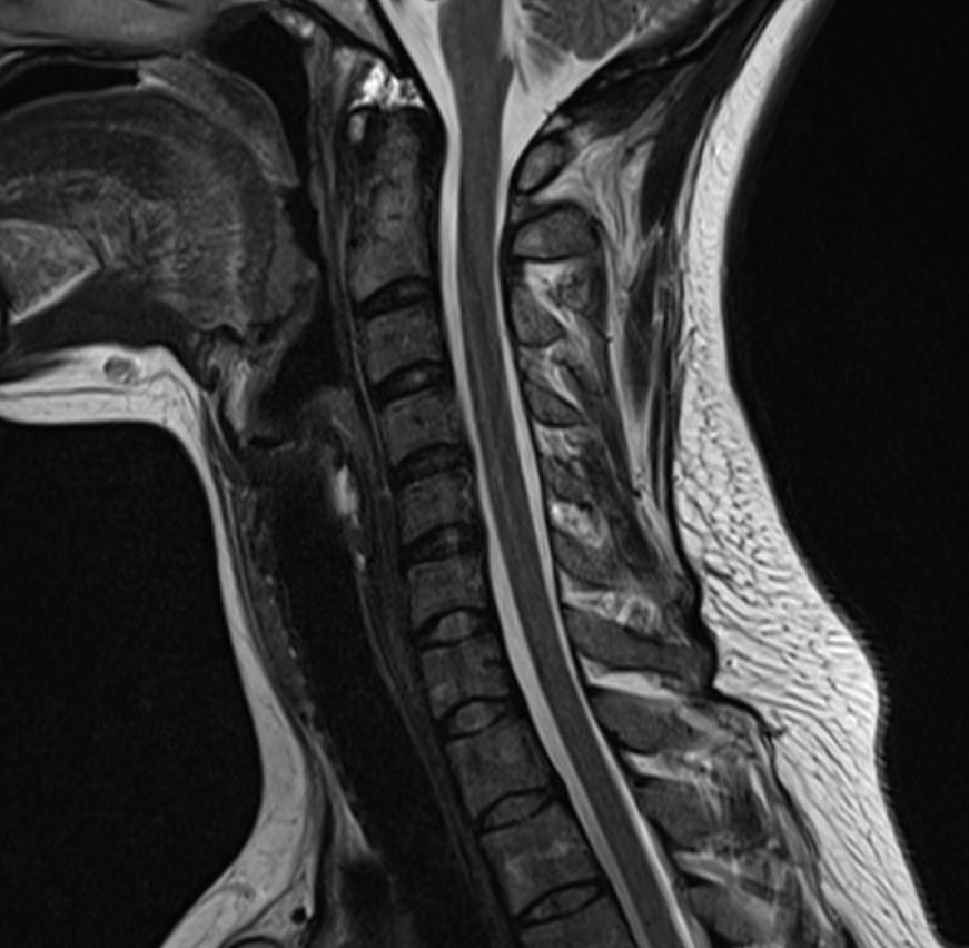 Normal cervical spine MRI sagittal