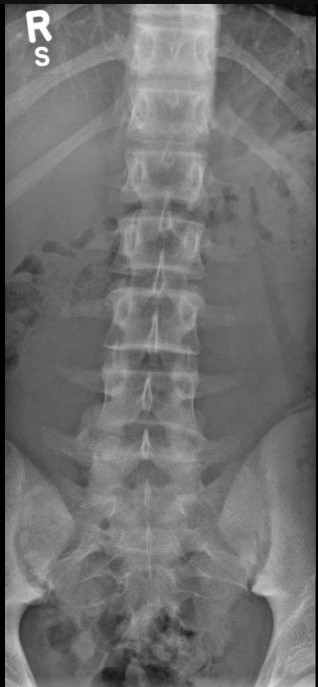 Normal lumbar spine AP x-ray