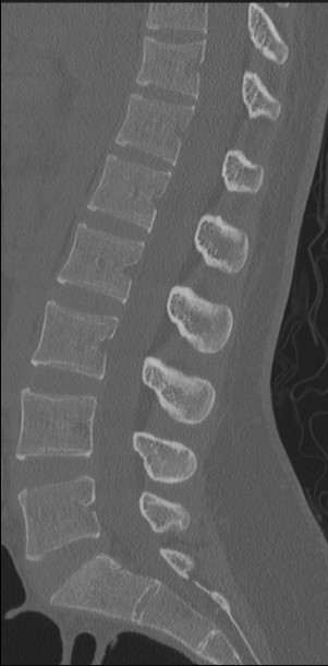 Normal lumbar spine CT sagittal