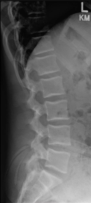 Normal lumbar spine lateral x-ray