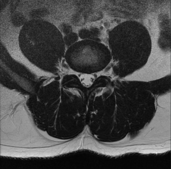 Normal lumbar spine MRI axial