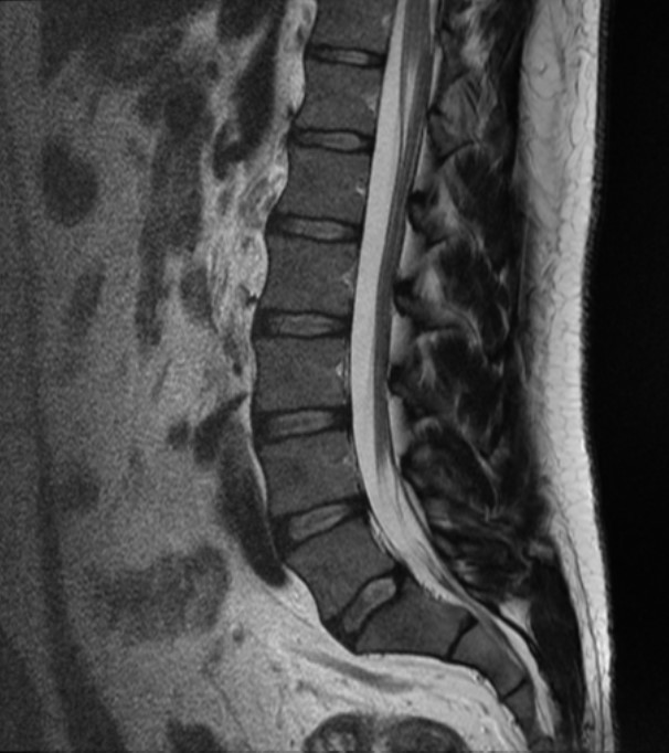 Normal lumbar spine MRI sagittal