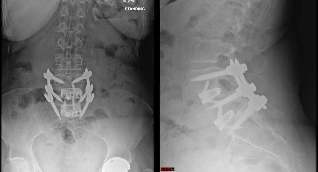 ALIF — postoperative