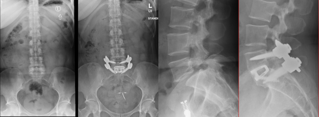 ALIF — pre and postoperative