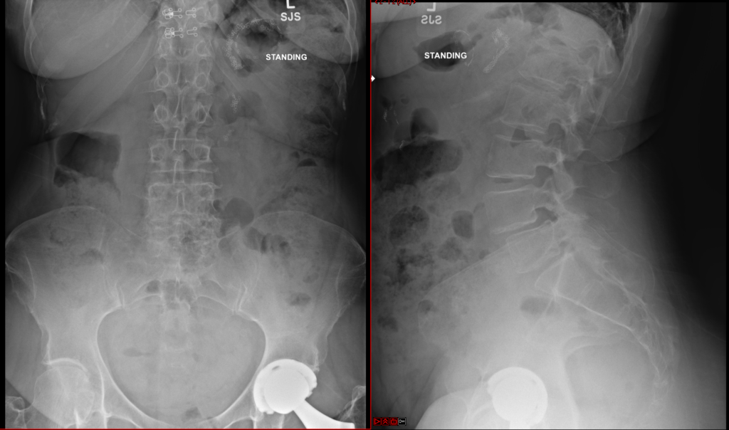 ALIF — preoperative