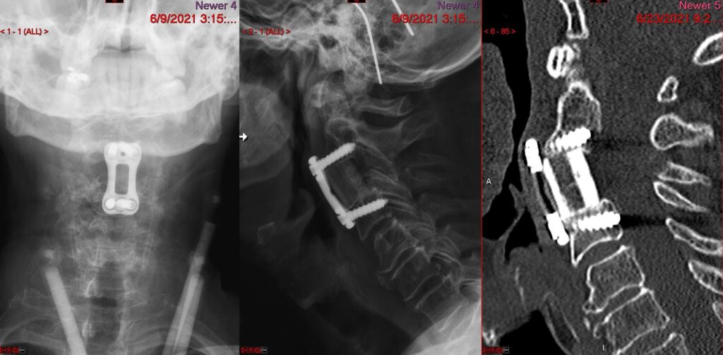 Cervical corpectomy — postoperative