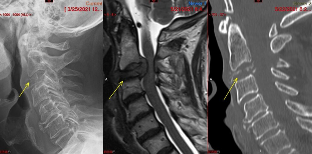 Cervical corpectomy — preoperative