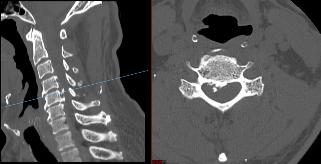 C5 corpectomy, CT