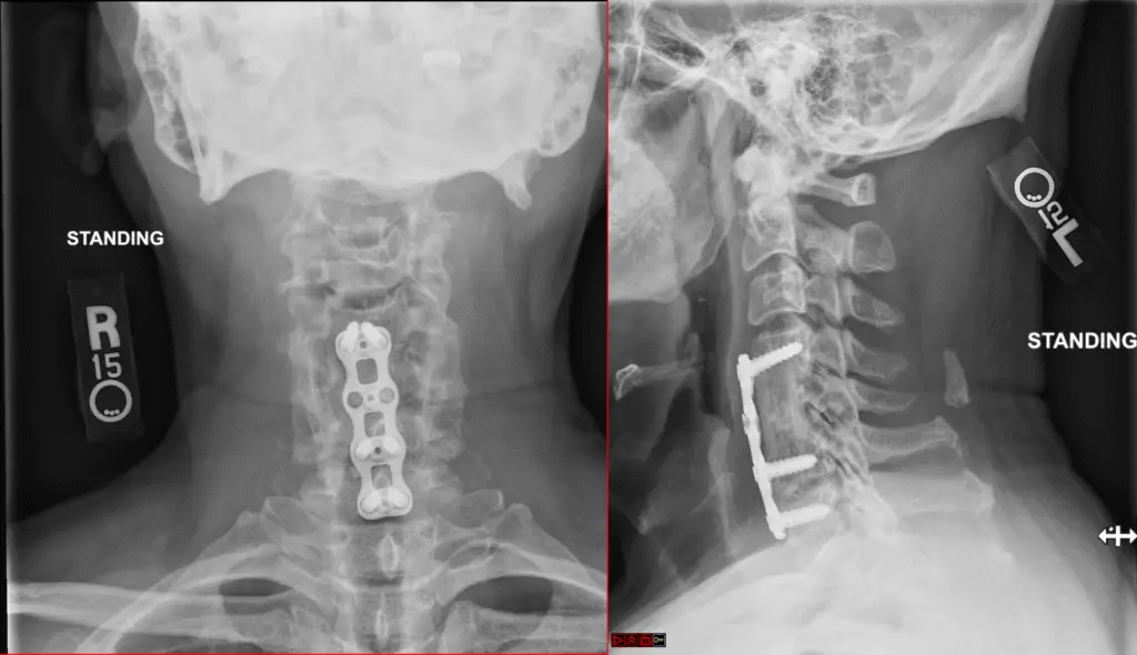 Anterior cervical C5 corpectomy and fusion