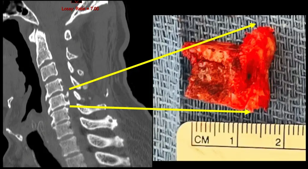 C5 corpectomy