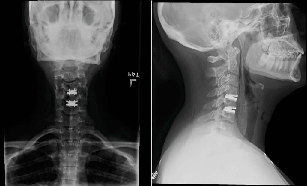Cervical disc replacement, lateral