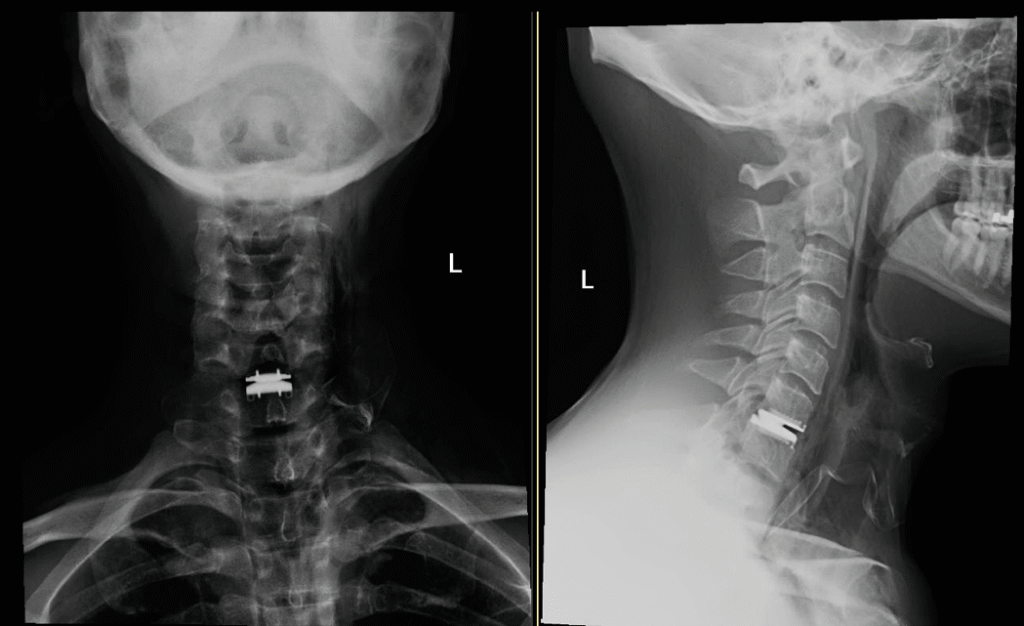 Cervical disc replacement