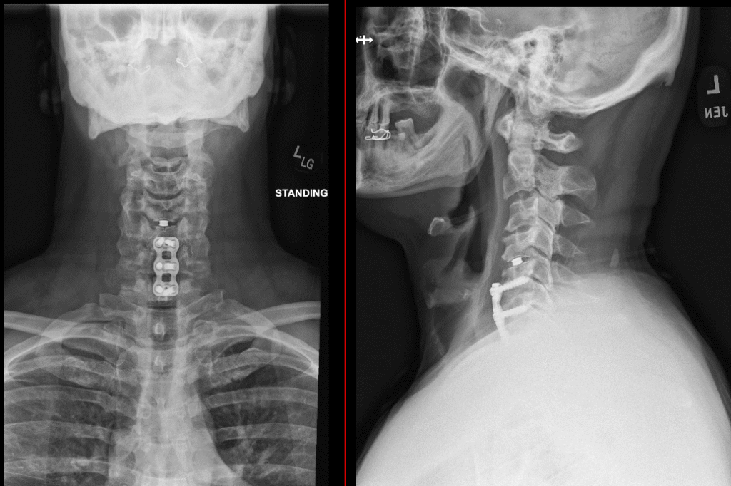 Hybrid surgery — disc replacement and fusion