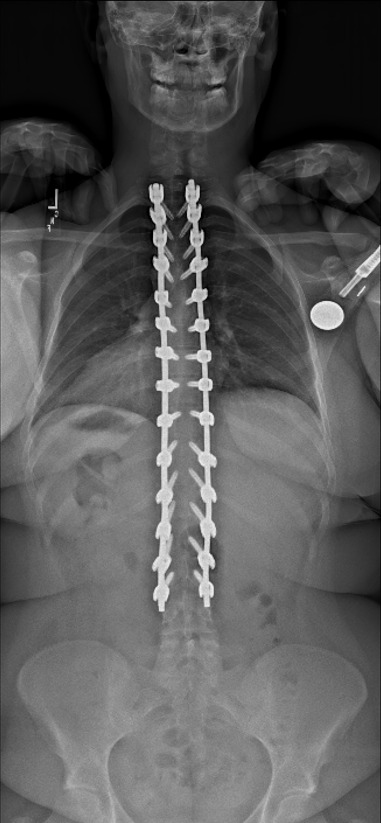 Standing AP x-ray after kyphosis correction and posterior instrumentation