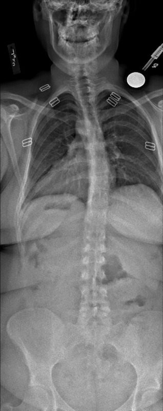Standing AP x-ray of thoracic kyphosis before correction