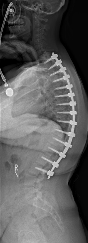 Standing lateral x-ray after kyphosis correction and osteotomy