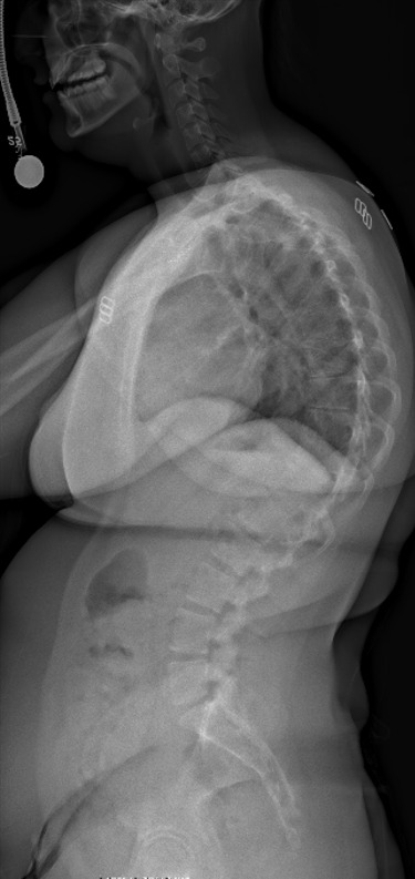 Standing lateral x-ray of thoracic hyperkyphosis before osteotomy