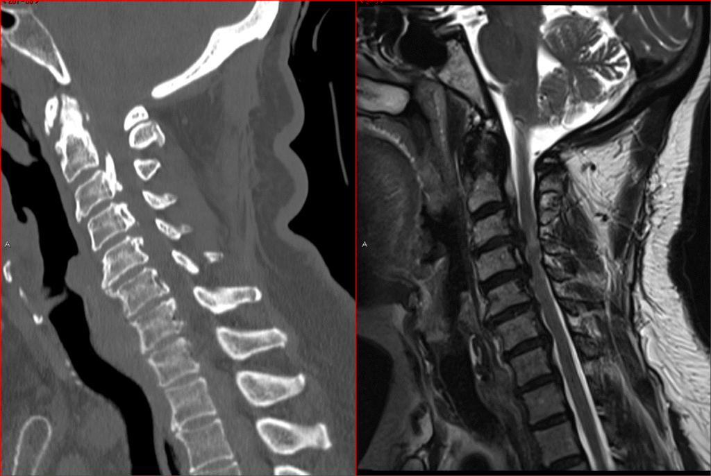 Cervical myelopathy