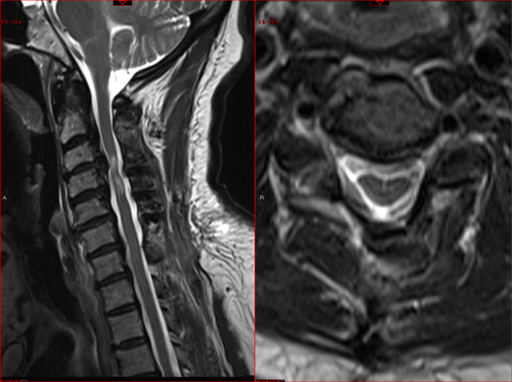 After laminoplasty