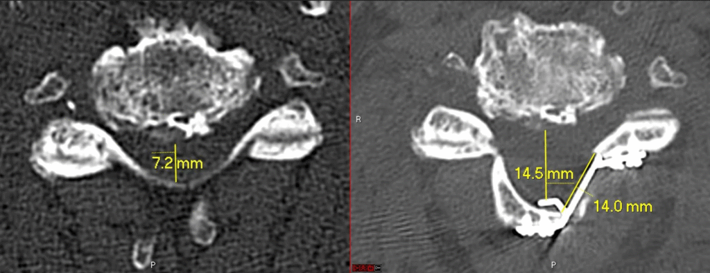 Laminoplasty — increased canal size