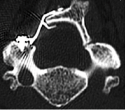 Laminoplasty — preoperative