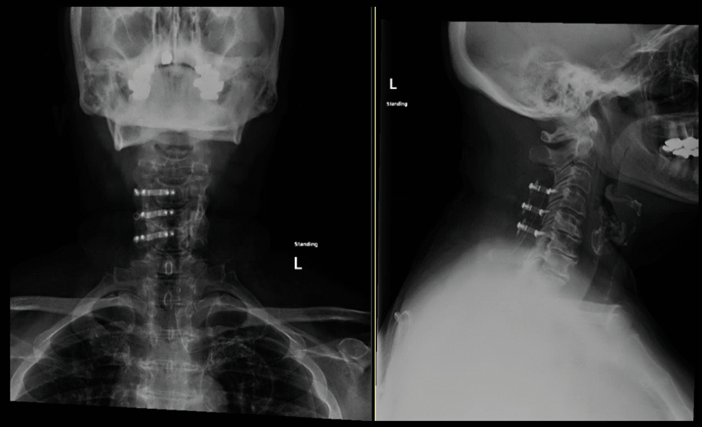 Laminoplasty