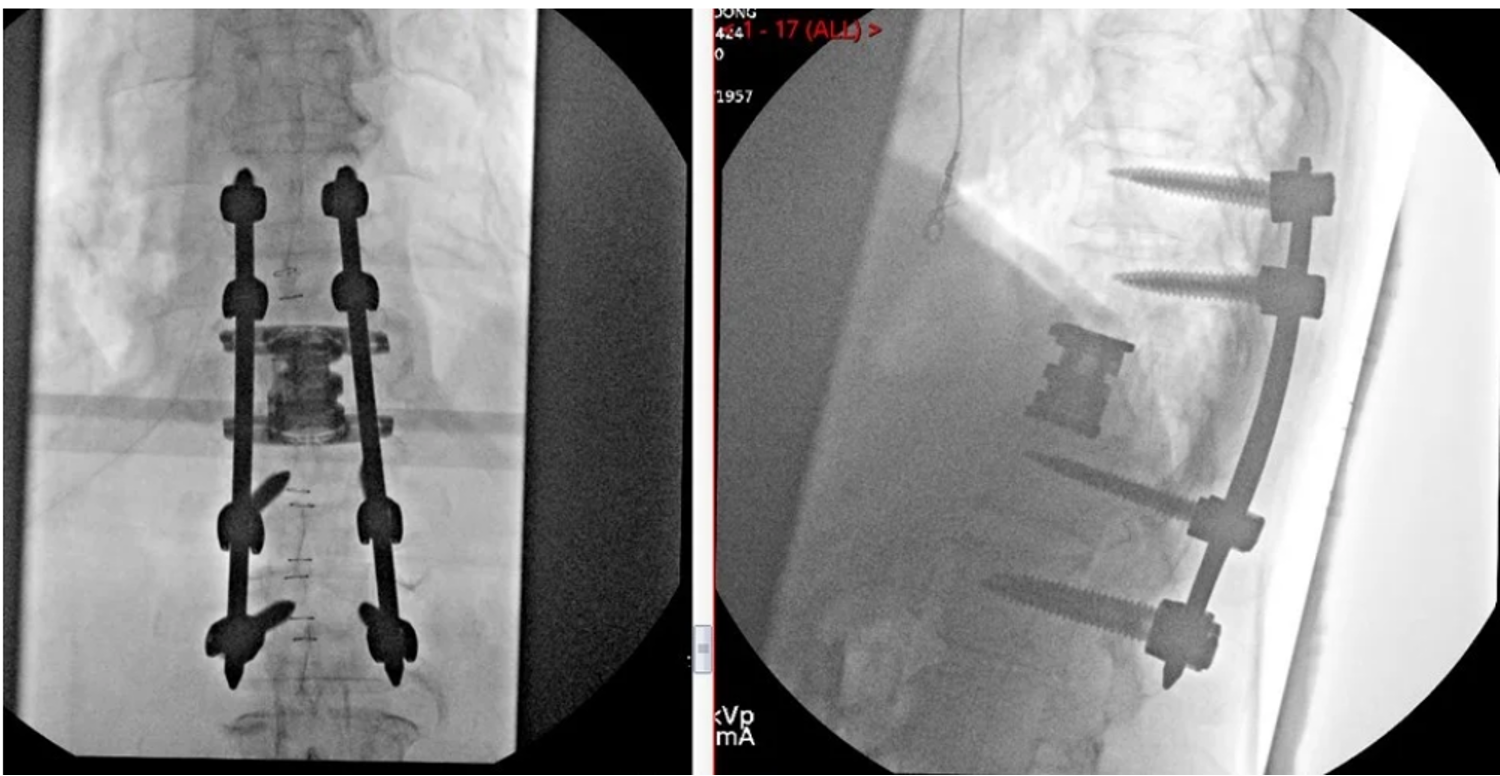 AP and lateral fluoroscopy after lateral corpectomy with cage and screws