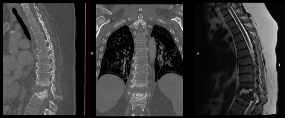 Sagittal CT, coronal CT, and sagittal MRI of the thoracic spine before lateral corpectomy