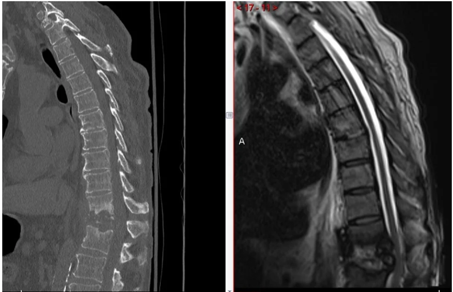 Side-by-side sagittal CT and MRI of the thoracic spine before lateral corpectomy
