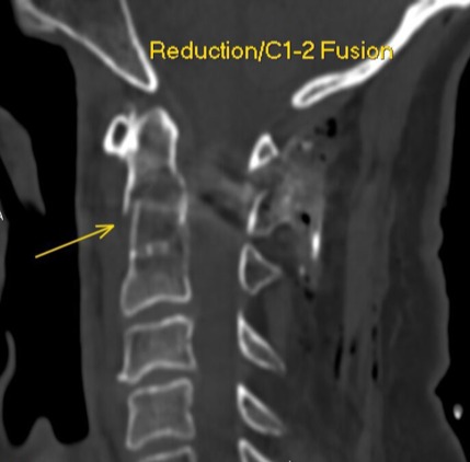 Sagittal CT after reduction and C1–2 posterior fusion
