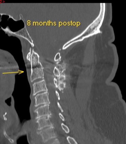Sagittal CT eight months after C2 fracture treatment