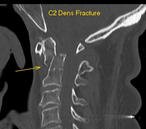 Sagittal CT of a C2 dens fracture