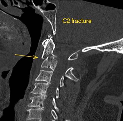 Sagittal CT of a C2 fracture