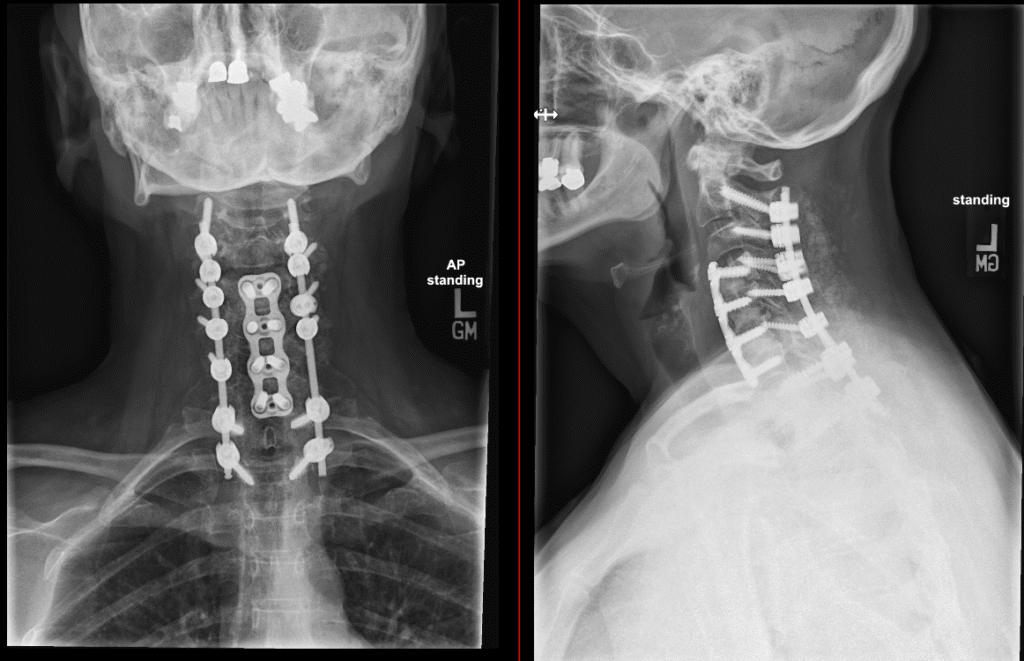 Posterior cervical fusion C2–T2
