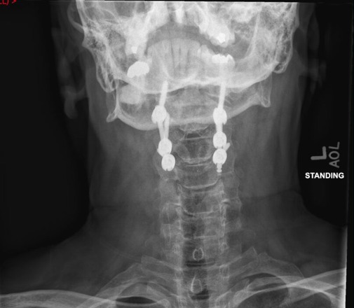 Standing AP x-ray after posterior cervical fusion