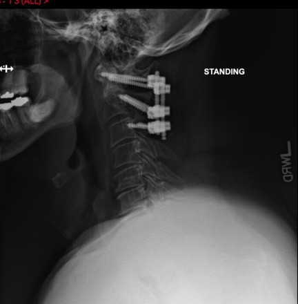 Standing lateral x-ray after posterior cervical fusion