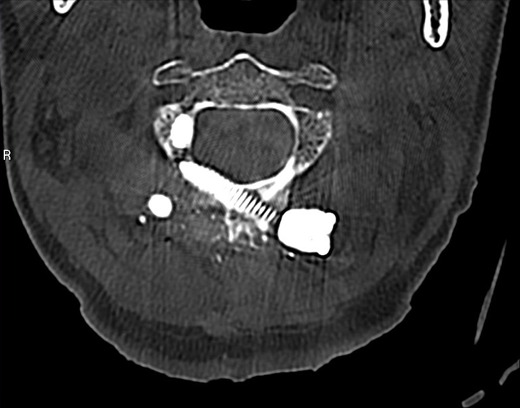 Postoperative axial CT after C1–2 fusion with screws