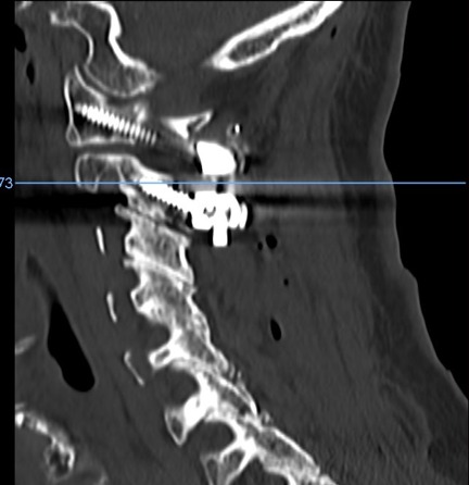 Postoperative sagittal CT after C1–2 fusion with screws