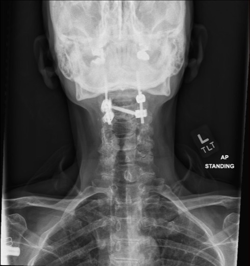 Standing AP x-ray after C1–2 posterior fusion