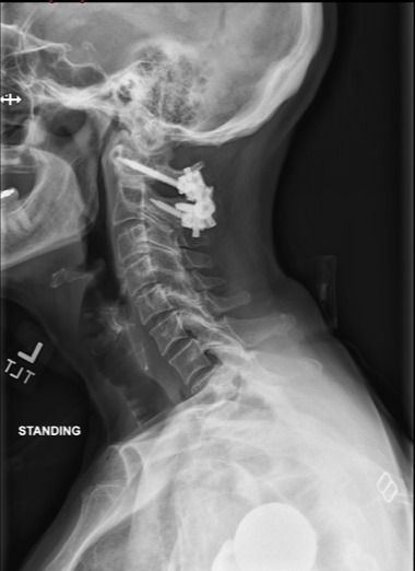 Standing lateral x-ray after C1–2 posterior fusion
