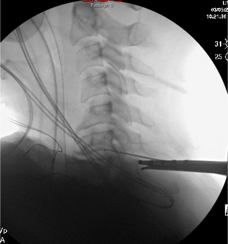 Intraoperative lateral fluoroscopy with an instrument at the cervical foramen