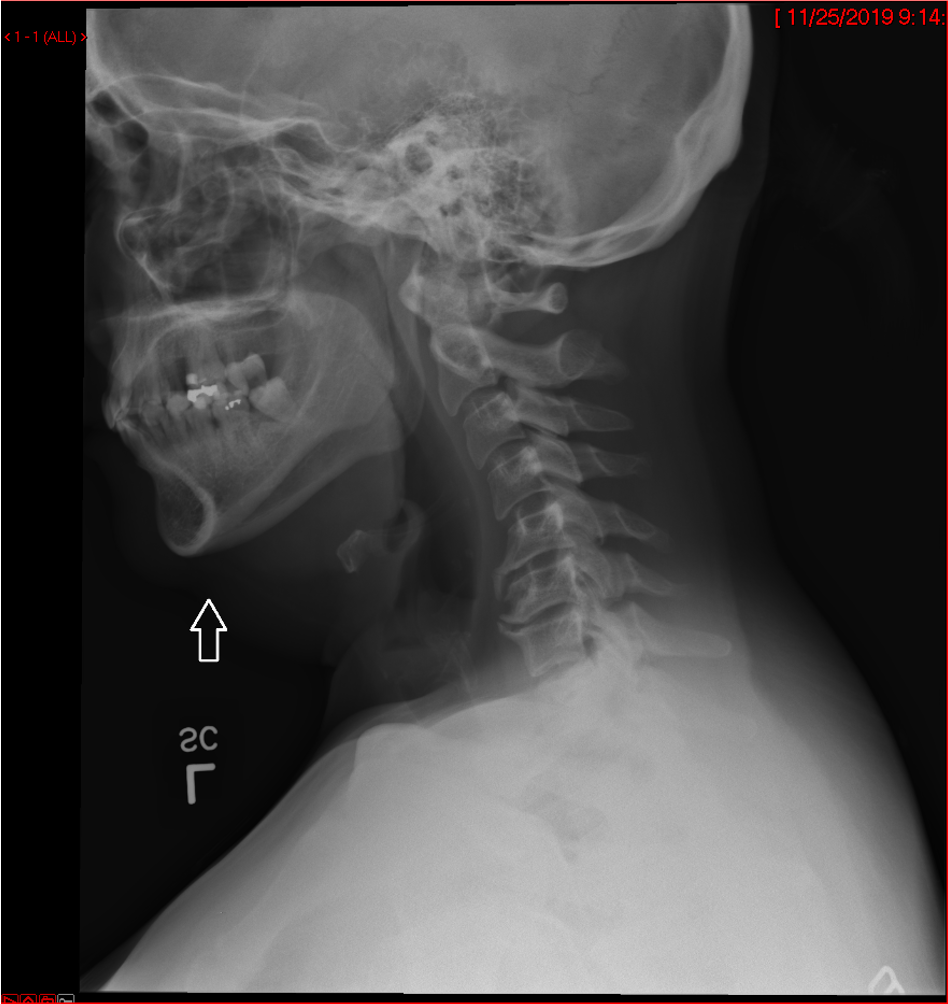 Lateral cervical x-ray without fusion hardware after posterior foraminotomy