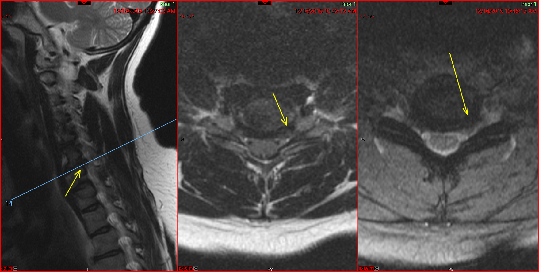 Sagittal and axial cervical MRI with arrows at the compressed foramen