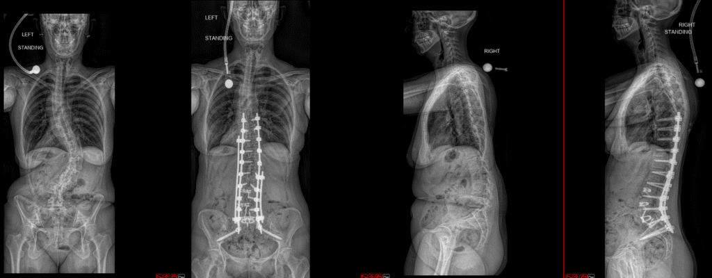 ALIF and T10–pelvis