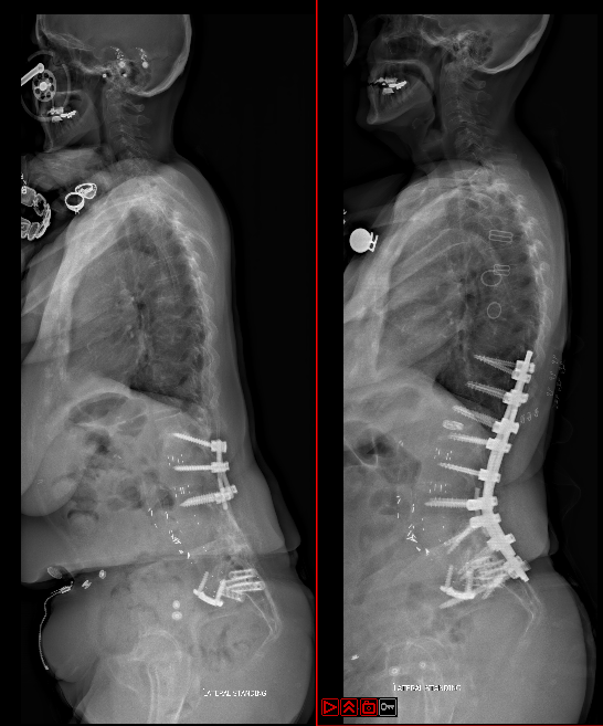 L4 pedicle subtraction osteotomy
