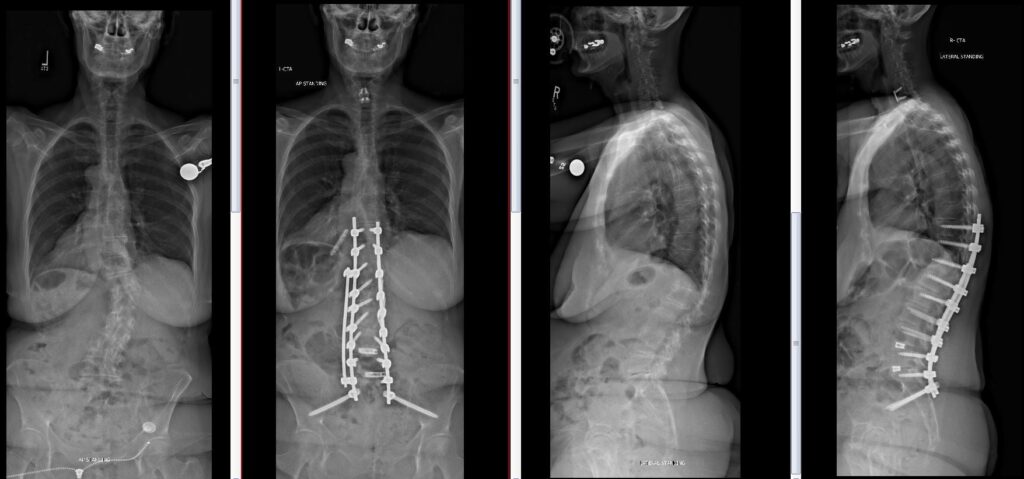T10–pelvis